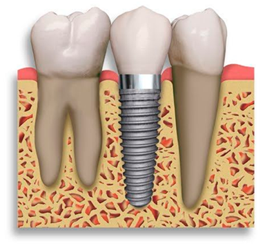 dent9
